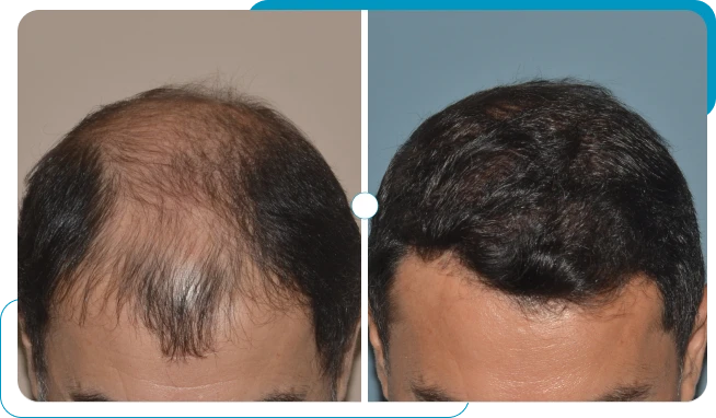 Caso real 1 de transplante capilar FUE
