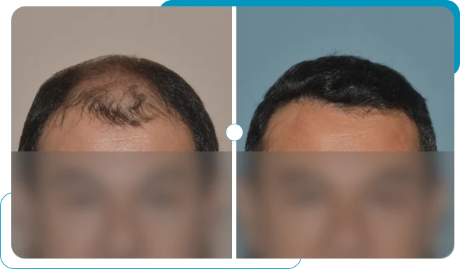 Caso real 2 de transplante capilar FUE