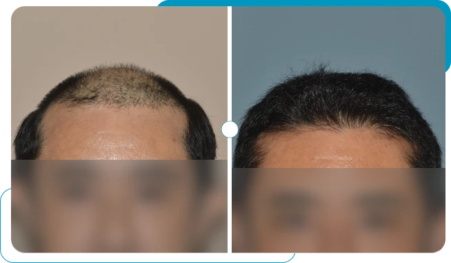 Caso real 3 de transplante capilar FUE