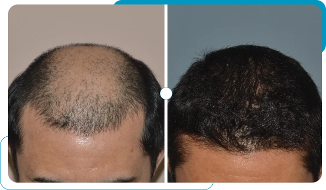 Caso real 4 de transplante capilar FUE