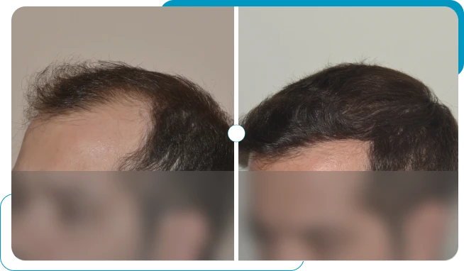 Caso real 5 de transplante capilar FUE