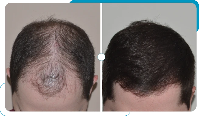 Caso real 6 de transplante capilar FUE