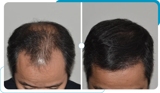 Caso real 7 de transplante capilar FUE