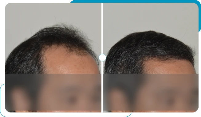 Caso real 8 de transplante capilar FUE