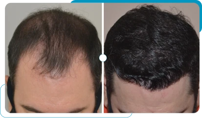 Caso real 9 de transplante capilar FUE