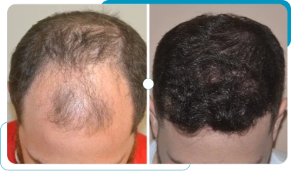 Caso real 10 de transplante capilar FUE